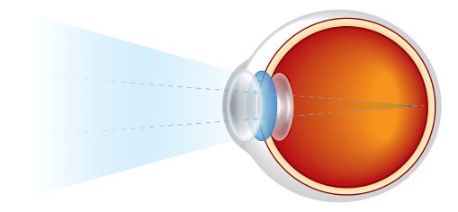 Macular Degeneration