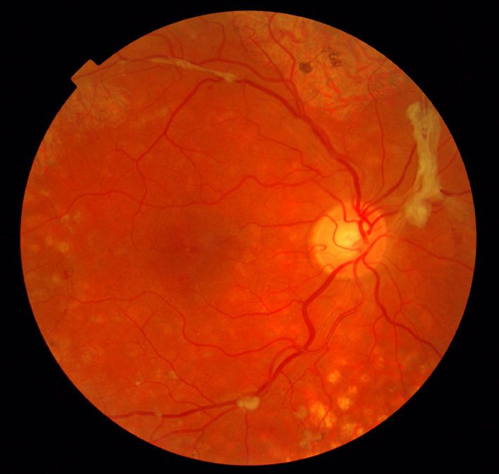 Advanced Diabetes Eye Disease