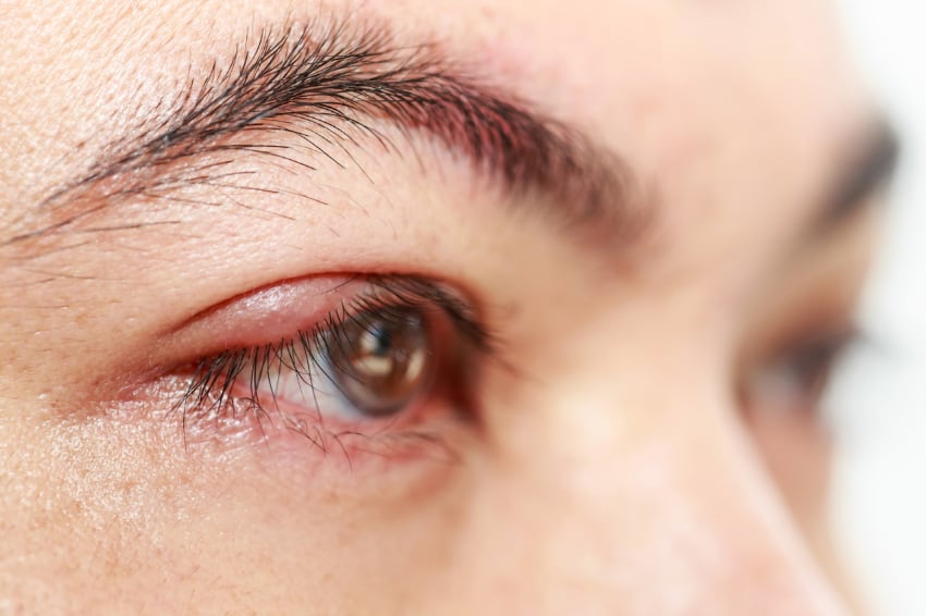 What is Blepharitis?