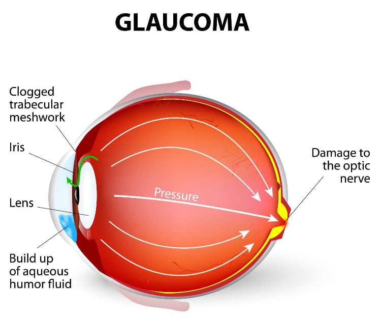 What is Glaucoma