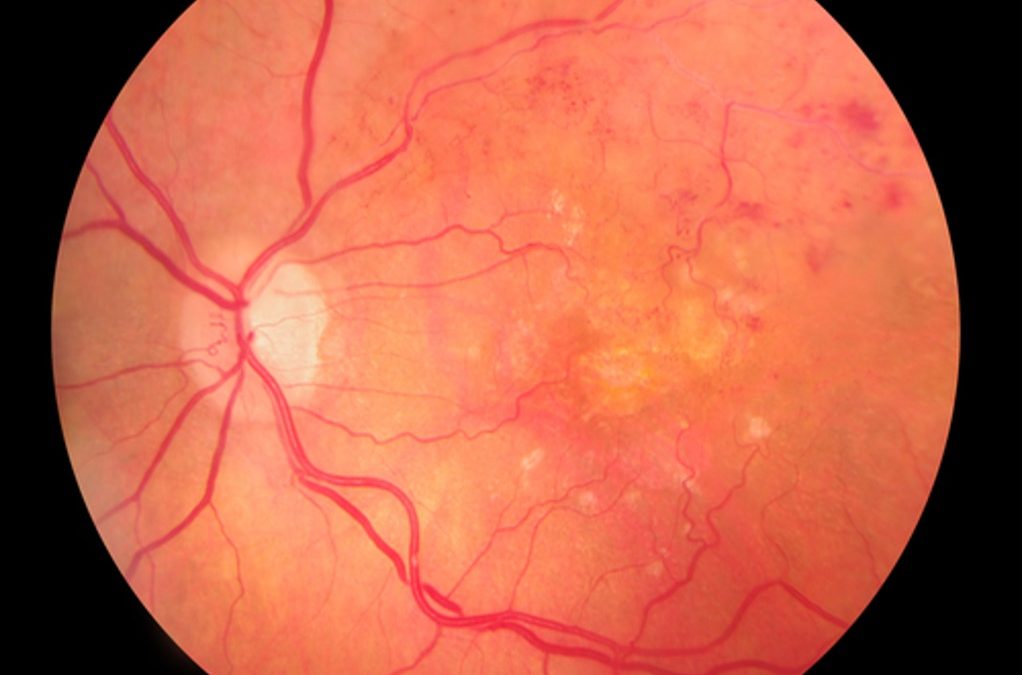 Retinal Vein Occlusion