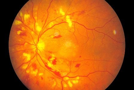 hypertensive retinopathy vs normal