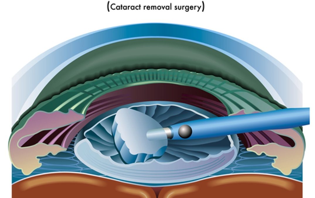 Cataracts and how do they affect my vision